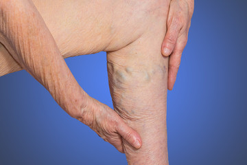 Fototapeta premium The varicose veins on a legs of old woman on blue