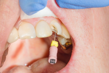 Dental treatment in dental clinic. Rotten carious tooth macro. Treatment endodontic canals