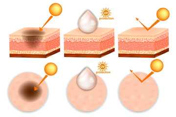 UV Protection. UV reflection skin before and after protection. Protect and Support healthy skin in the sun