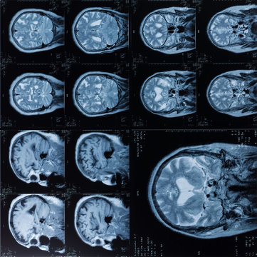 Head MRT. MR image of human brain