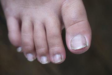 Dirty children finger nails. Dirty finger nails.