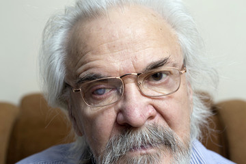 Eye disease in an old man