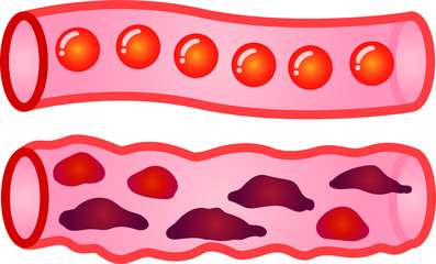 Healthy blood vessel and Unhealthy blood vessel 1