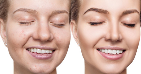 Young woman before and after skin treatment.