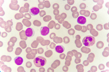 White blood cells in blood smear, analyze by microscope
