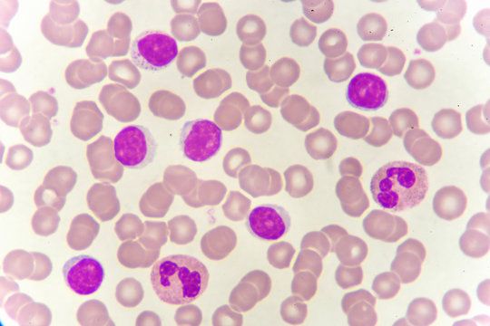 White blood cells in blood smear, analyze by microscope © jarun011