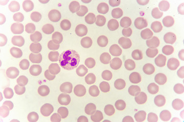 Neutrophil cell (white blood cell) in blood smear, analyze by microscope