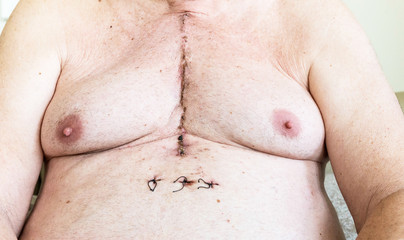 Surgical scar from cardiac surgery of coronary artery disease - obrazy, fototapety, plakaty