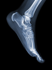 Deformed feet - pes planus