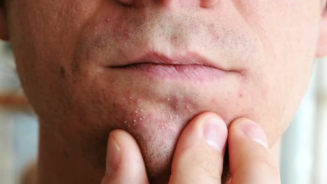 Skin irritation after shaving. Man's hands squeeze pimples on the chin. Closeup chin, lips.