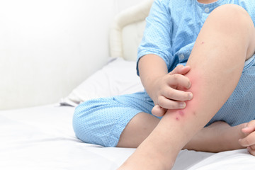 Obraz na płótnie Canvas Hand scratching ,legs of fat boy with swelling spot