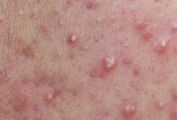Acne on facial skin, Dermatological disease acne