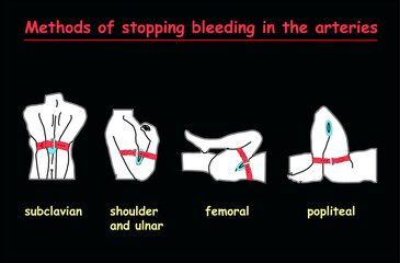 methods of stopping bleeding in the arteries white body on black background .  Education vector info graphic