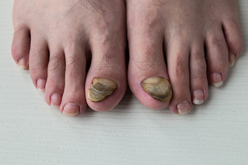 nail fungus care or nail fungus treatment. medical concept.  © Fertas