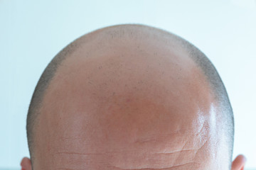 View of bald man's head