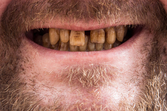smoker's teeth, the smoker's close-up smile, the dentist's dream