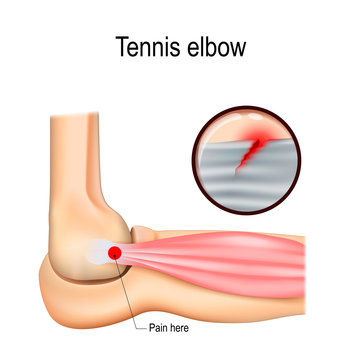 Tennis elbow or lateral epicondylitis.
