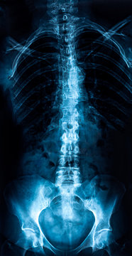 Old woman spine x-ray
