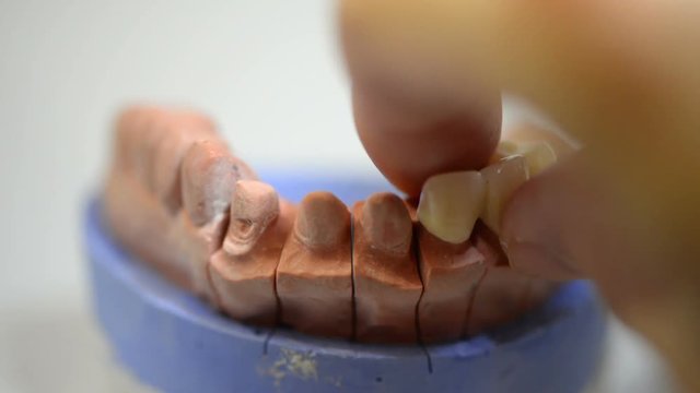 Dental technician working on 3D printed mold for tooth implants in the lab