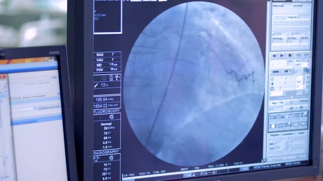 Human heart beating. Heart X-ray on a screen.