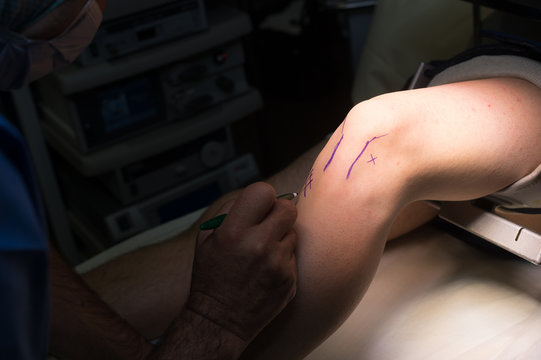 LIGAMENT SURGERY