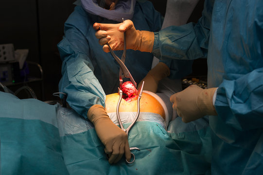HIP PROSTHESIS SURGERY