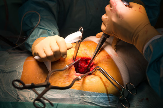 HIP PROSTHESIS SURGERY