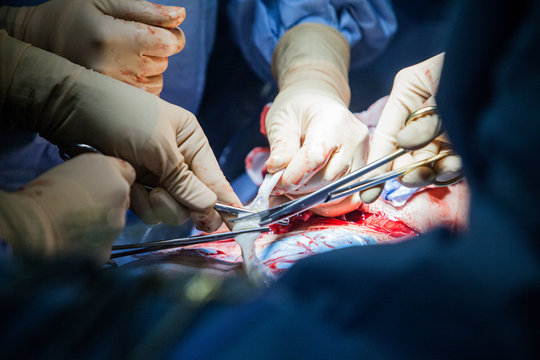 CESAREAN BIRTH