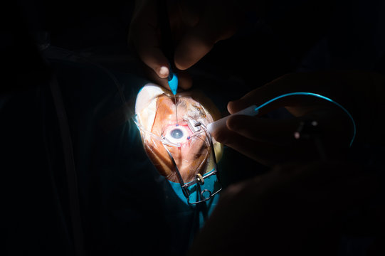 RETINAL DETACHMENT SURGERY