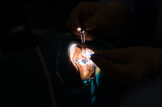 RETINAL DETACHMENT SURGERY