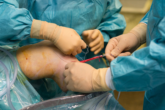 LIGAMENT SURGERY