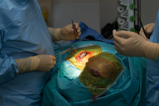 DEEP BRAIN STIMULATION