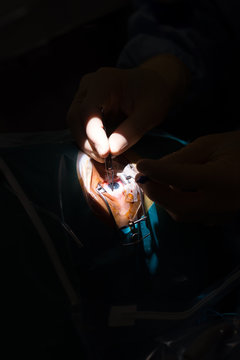 RETINAL DETACHMENT SURGERY