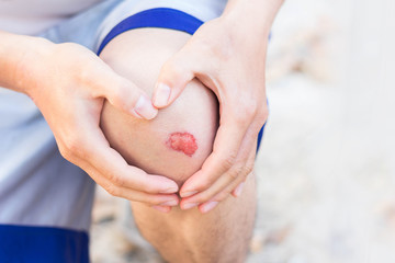 Man show lesion or wound on his knee after accident
