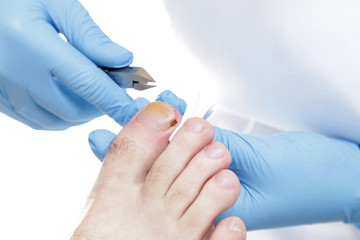 Wrastający paznokieć. Podologia