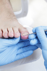 Wrastający paznokieć. Zakładanie tamponady.  Podologia