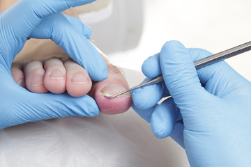 Wrastający paznokieć. Zakładanie tamponady.  Podologia