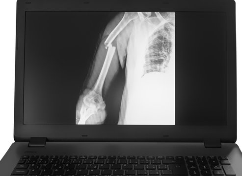 X-ray image of broken arm on monitor of pc