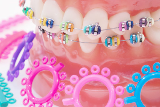 orthodontic model and dentist tool - demonstration teeth model of varities of orthodontic bracket or brace