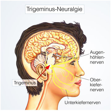 Trigeminus&auml;ste.Trigeminus-Neuralgie