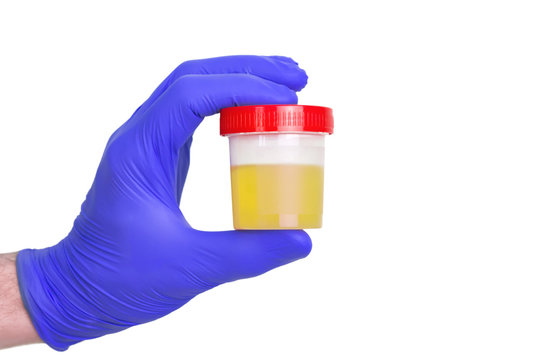 A gloved doctor hand with the urine container for medical urine test. A photo of urine specimen, medical analysis in the laboratory. Urine sample isolated on white with place for text, copyspace.