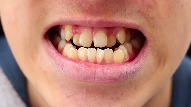 Crooked, crowded, and protruding teeth. A malocclusion happens when mismatched teeth and the jaw cause a person to have a bad bite