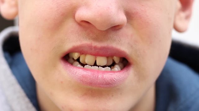 Crooked, crowded, and protruding teeth. A teen to have a bad bite