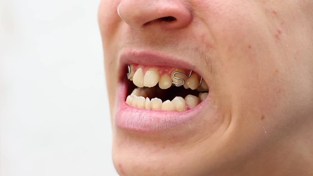 Bad bite problems — treatments for malocclusion. Braces. Bite correction. Crooked, crowded, and protruding teeth