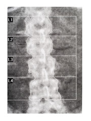 Bone density DEXA scan. Osteoporosis diagnosis.