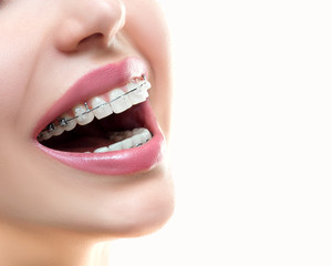 Closeup Ceramic and Metal Braces on Teeth.
Self ligating Dental Brackets.