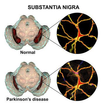 Substantia Nigra In Norm And In Parkinson's Disease, 3D Illustration Showing Decrease Of Its Volume. There Is Degeneration Of Dopaminergic Neurons In The Pars Compacta Of The Substantia Nigra