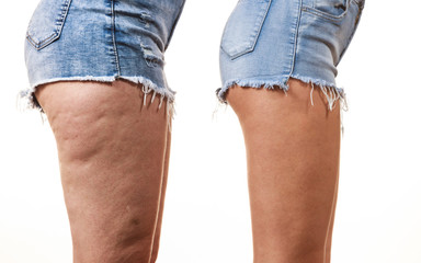 Comparison of legs with and without cellulite