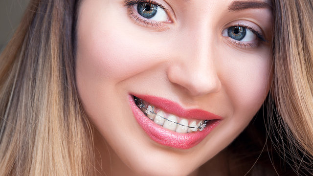 Close up Ceramic and Metal Braces on Teeth. Beautiful Female Smile with Self-ligating Braces. Orthodontic Treatment. 