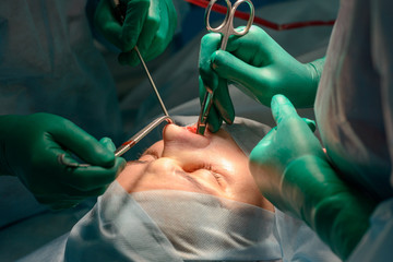 Plastic surgery of the nose in operating room, rhinoplasty